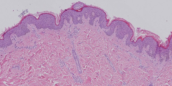 Melanoma maligno: percorso terapeutico